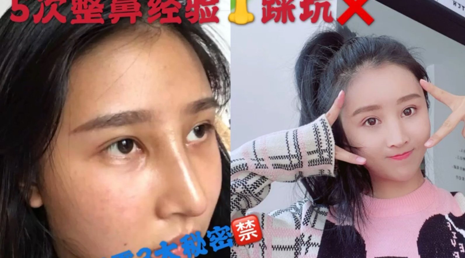 花费50w, 做了5次的鼻子...